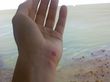 Así le quedó la mano a la colombiana después del ataque